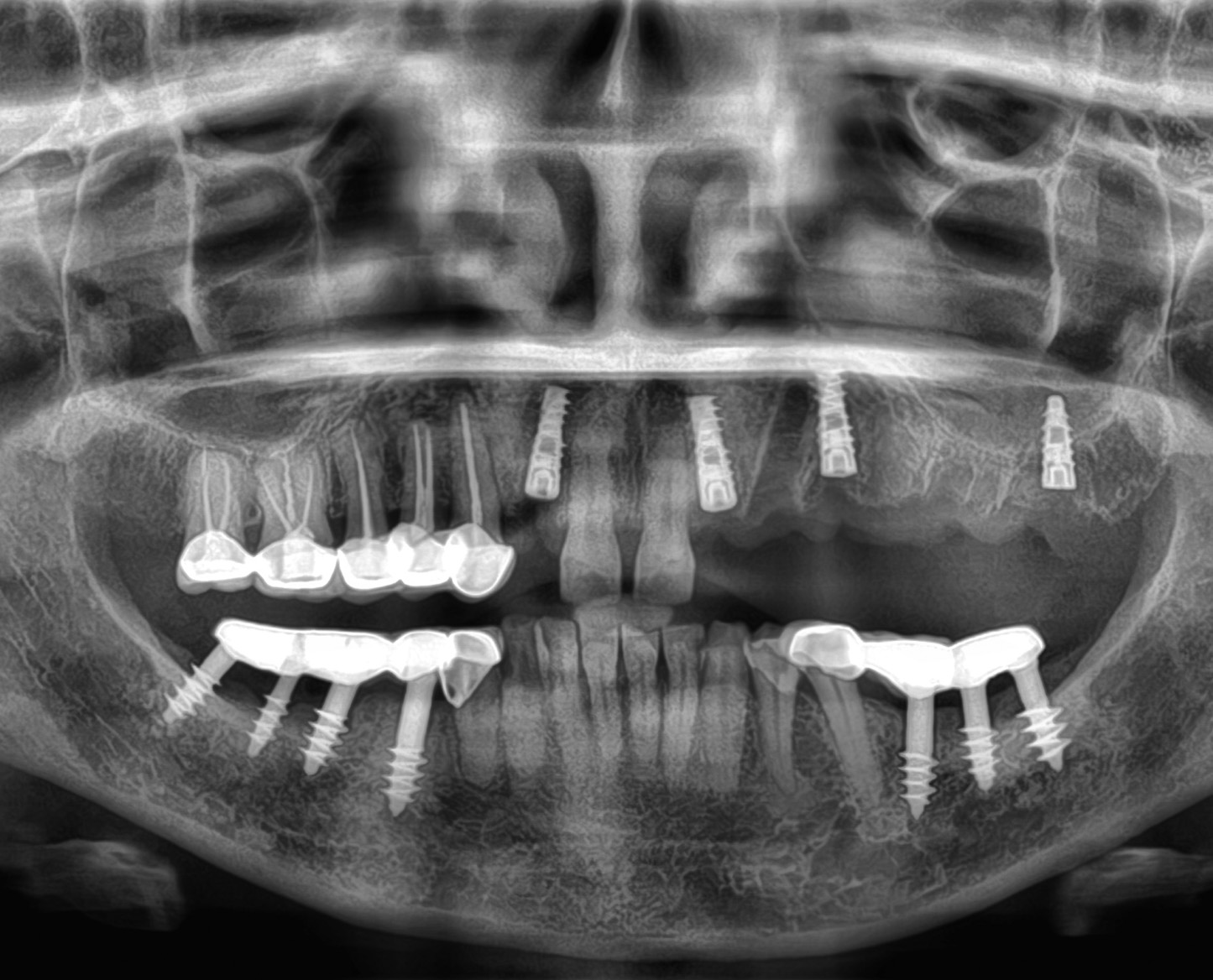 implant best Implants surgery
