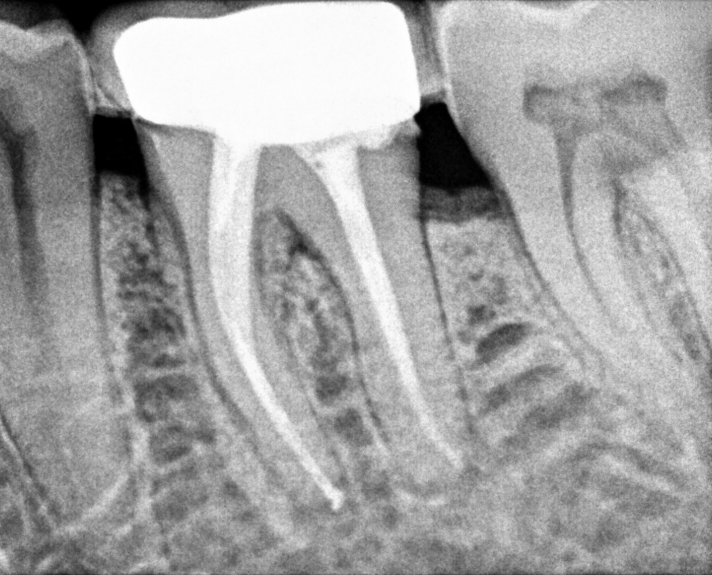 rct rootcanaltreatment